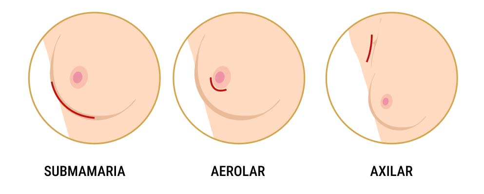 procedimiento mamoplastia de aumento
