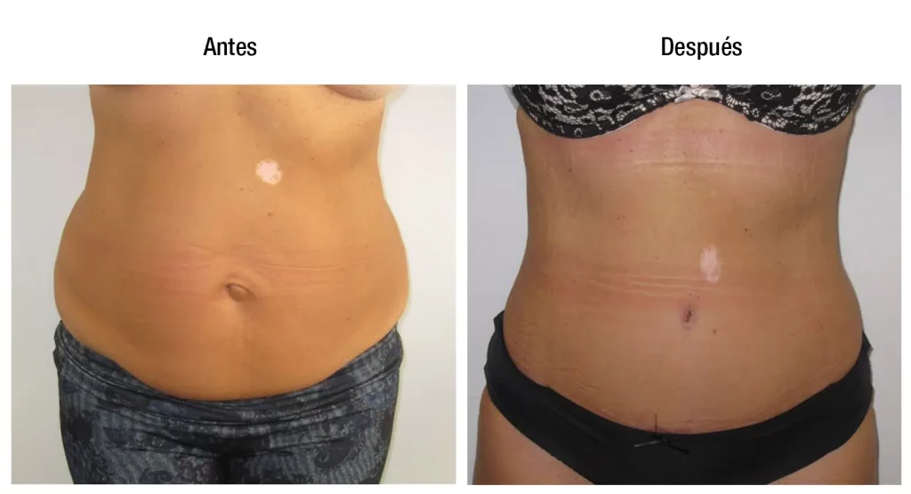 antes después liposucción 